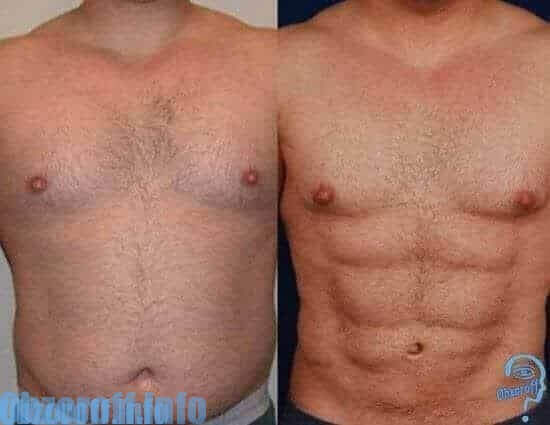 Hasil Sebelum dan Setelah Menggunakan Belt AB Gymnic untuk pers