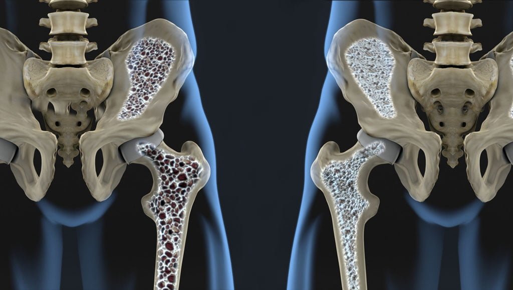 Osteoporozën