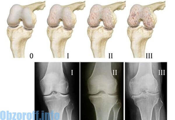 artroz 1 y stepeni - The main signs of various stages of arthrosis of the joints