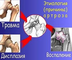 The causes of arthrosis