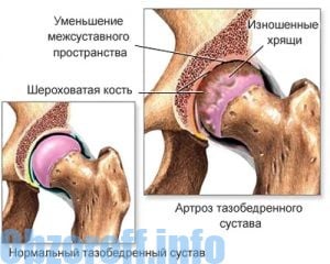 artroz sustava taza - Arthrosis sendi panggul dan metode pengobatan