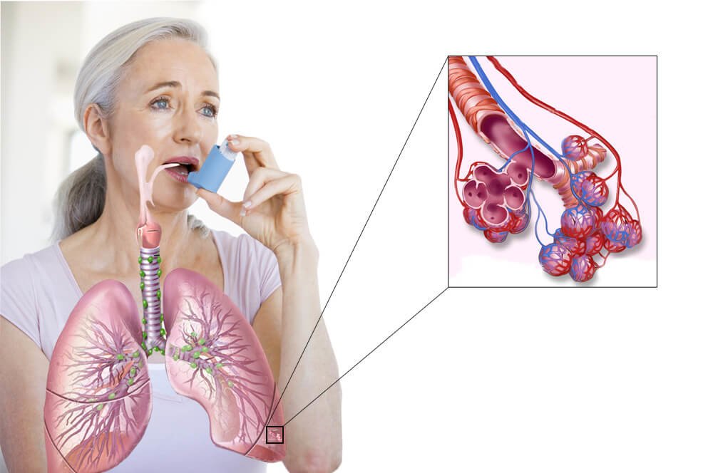 Як лячыць астму