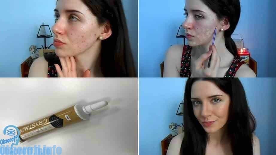 Spot cream Crystaline for acne do i posle