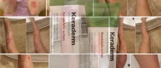 keraderm krem dlya lecheniya bệnh vẩy nến - Keraderm để điều trị bệnh vẩy nến: mô tả về kem, hướng dẫn