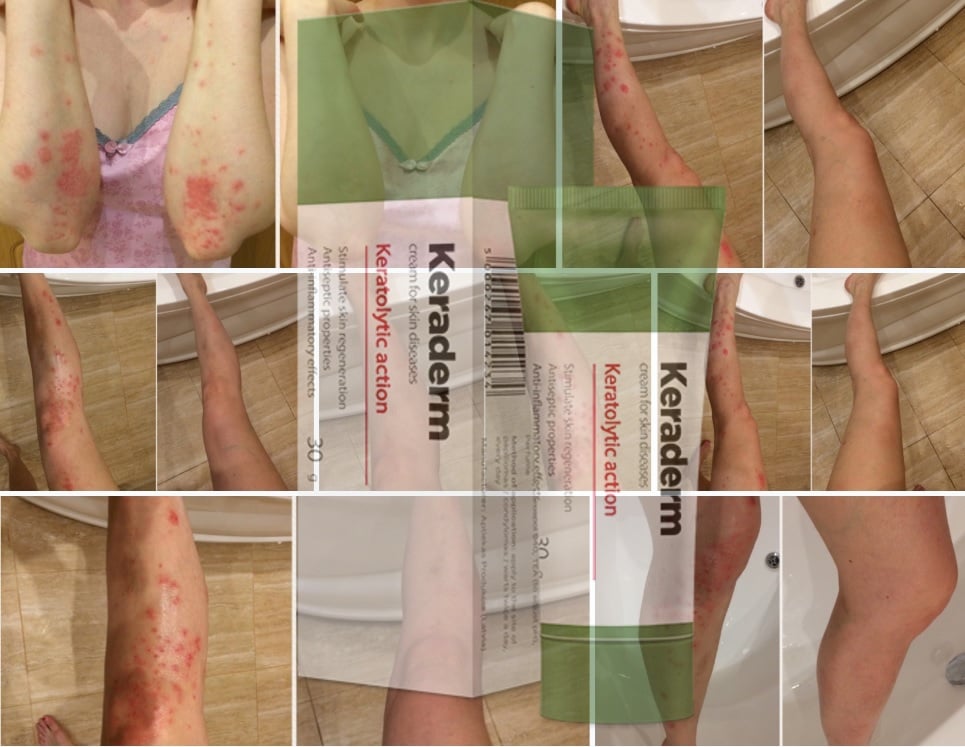 Cream Keraderm for the treatment of psoriasis