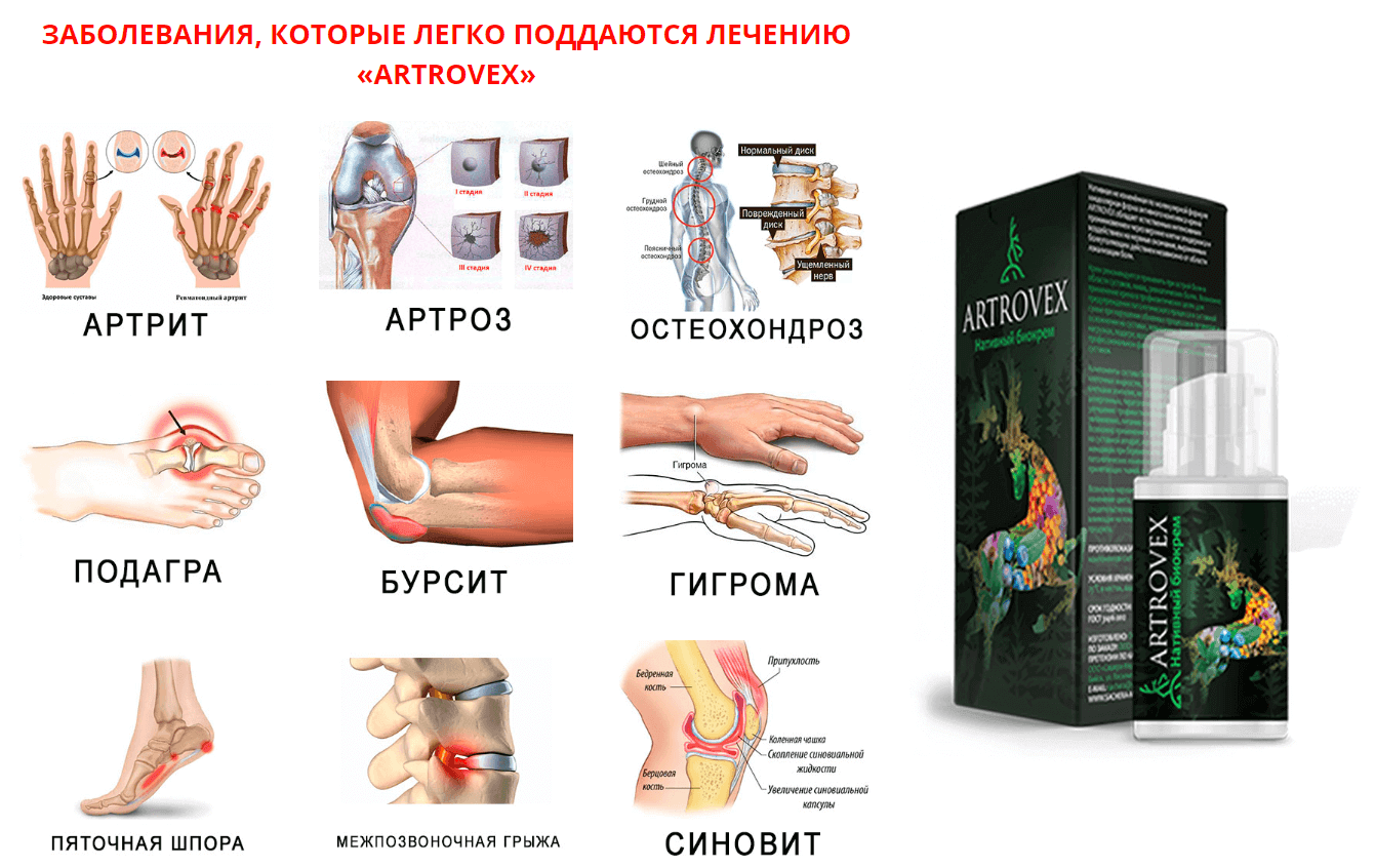 lechenie zabolevaniy sustavov kremom - Крем Artrovex для лечения артрита и заболеваний суставов