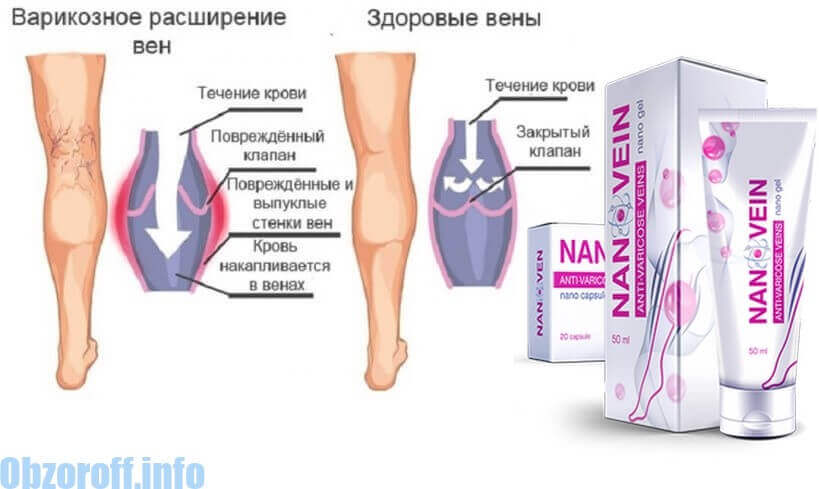 Crema de la varicoza pe picioare nano - Protocolul internaional pentru varicoze