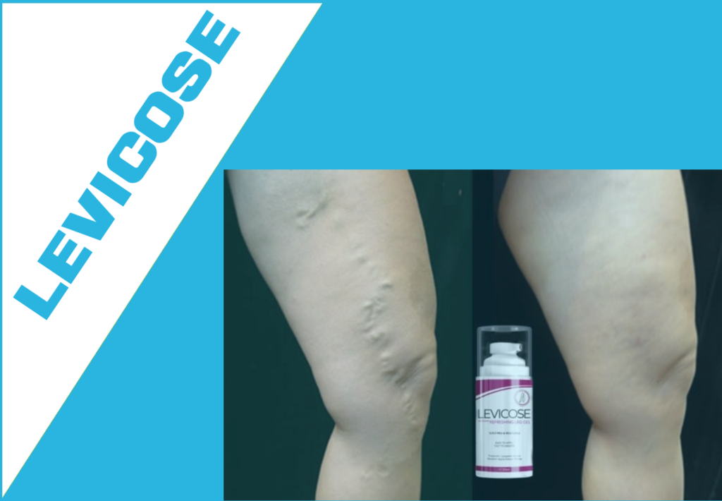 Levicose: A detailed review of the properties of the gel for the treatment and prevention of varicose veins
