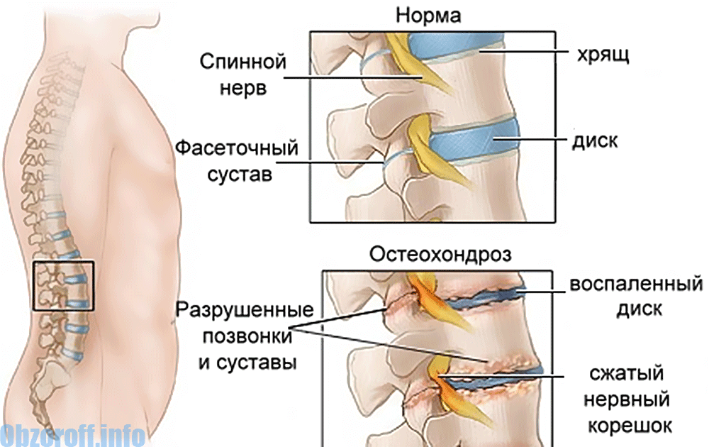 osteohondroz - Bagaimana proses osteochondrosis: Periarthrosis dan Coccygodynia