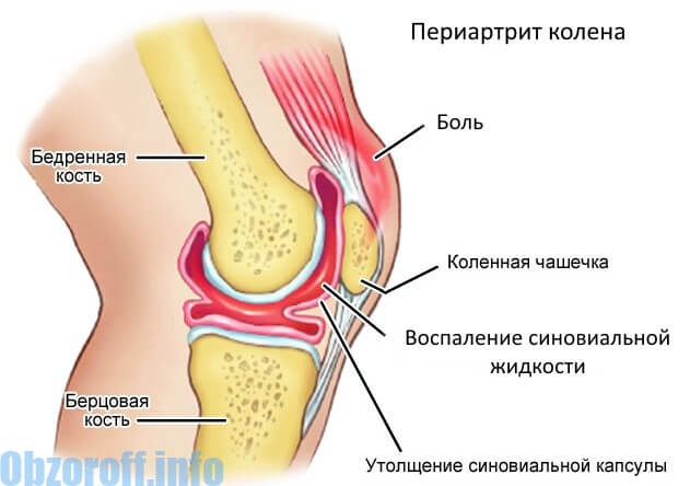 Periarthrosis of the knee