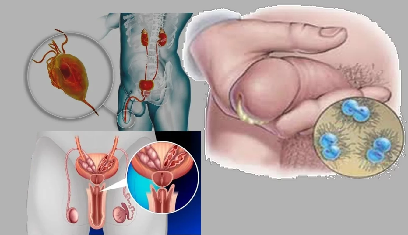 La prostatite et les causes de brûlure dans l'urètre