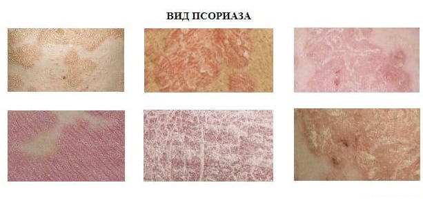 Types de psoriasis