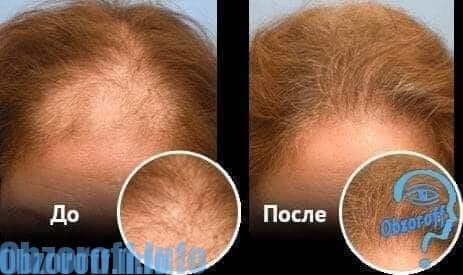 kā darbojas matu laka Ultra Hair System