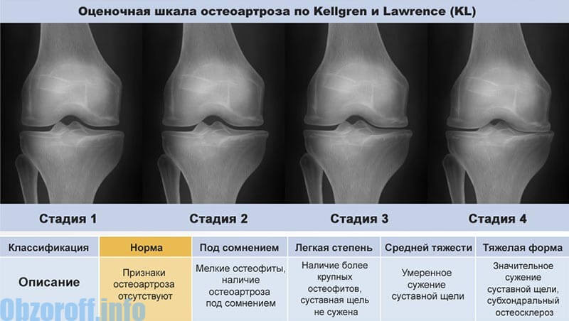 4 štádium artrózy kĺbov